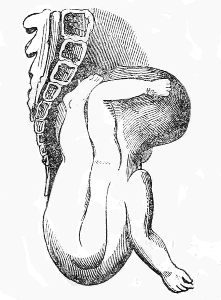 Descent of the shoulder and trunk