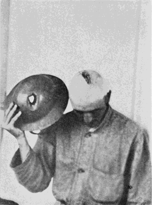 SERGT. NICHOLSON, SHOWING HIS WOUNDED SKULL AND HELMET WORN WHEN WOUND WAS RECEIVED