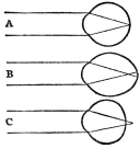 EYE LENS—NORMAL AND DEFECTIVE  A, normal eye; B, myopic eye; C, hyperopic eye (From Martin’s “Human Body”)