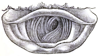 Involution of Trachea, due to aneurism