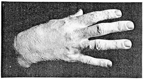 Cast of Liszt’s Hand