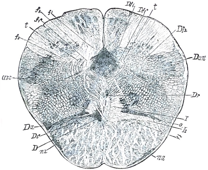 Decussating degeneration of interolivary layer