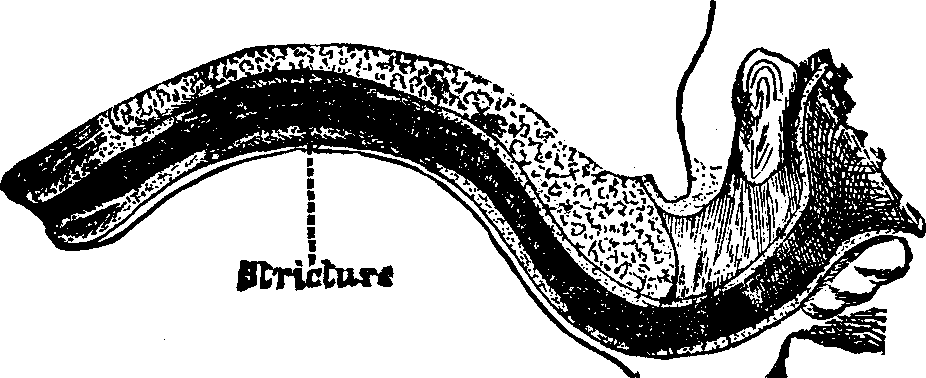 Illustration:
Fig. 2. A Single Stricture of the Urethra.